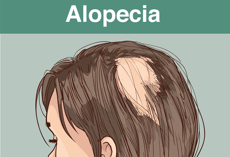alopecia